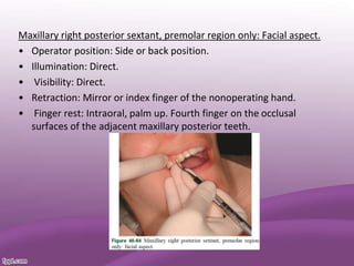 Maxillary right posterior sextant, premolar region only: Facial aspect.
• Operator position: Side or back position.
• Illumination: Direct.
• Visibility: Direct.
• Retraction: Mirror or index finger of the nonoperating hand.
• Finger rest: Intraoral, palm up. Fourth finger on the occlusal
surfaces of the adjacent maxillary posterior teeth.
 