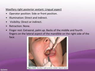 Maxillary right posterior sextant: Lingual aspect
• Operator position: Side or front position.
• Illumination: Direct and indirect.
• Visibility: Direct or indirect.
• Retraction: None.
• Finger rest: Extraoral, palm up. Backs of the middle and fourth
fingers on the lateral aspect of the mandible on the right side of the
face.
 
