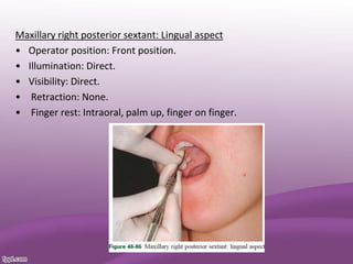 Maxillary right posterior sextant: Lingual aspect
• Operator position: Front position.
• Illumination: Direct.
• Visibility: Direct.
• Retraction: None.
• Finger rest: Intraoral, palm up, finger on finger.
 