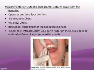 Maxillary anterior sextant: Facial aspect, surfaces away from the
operator
• Operator position: Back position.
• Illumination: Direct.
• Visibility: Direct.
• Retraction: Index finger of the nonoperating hand.
• Finger rest: Intraoral, palm up. Fourth finger on the incisal edges or
occlusal surfaces of adjacent maxillary teeth.
 