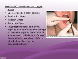 Maxillary left posterior sextant: Lingual
aspect
• Operator position: Front position.
• Illumination: Direct.
• Visibility: Direct.
• Retraction: None.
• Finger rest: Intraoral, palm down,
opposite arch, reinforced. Fourth finger
on the incisal edges of the mandibular
anterior teeth or the facial surfaces of
the mandibular premolars, reinforced
with the index finger of the
nonoperating hand.
 