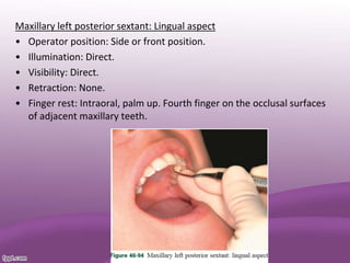 Maxillary left posterior sextant: Lingual aspect
• Operator position: Side or front position.
• Illumination: Direct.
• Visibility: Direct.
• Retraction: None.
• Finger rest: Intraoral, palm up. Fourth finger on the occlusal surfaces
of adjacent maxillary teeth.
 