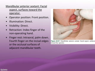 Mandibular anterior sextant: Facial
aspect, surfaces toward the
operator.
• Operator position: Front position.
• Illumination: Direct.
• Visibility: Direct.
• Retraction: Index finger of the
non-operating hand.
• Finger rest: Intraoral, palm down.
Fourth finger on the incisal edges
or the occlusal surfaces of
adjacent mandibular teeth.
 