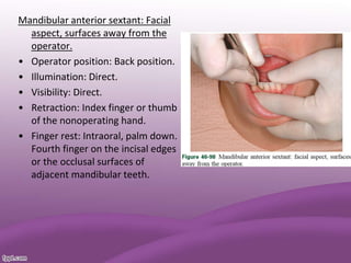 Mandibular anterior sextant: Facial
aspect, surfaces away from the
operator.
• Operator position: Back position.
• Illumination: Direct.
• Visibility: Direct.
• Retraction: Index finger or thumb
of the nonoperating hand.
• Finger rest: Intraoral, palm down.
Fourth finger on the incisal edges
or the occlusal surfaces of
adjacent mandibular teeth.
 
