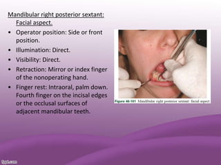 Mandibular right posterior sextant:
Facial aspect.
• Operator position: Side or front
position.
• Illumination: Direct.
• Visibility: Direct.
• Retraction: Mirror or index finger
of the nonoperating hand.
• Finger rest: Intraoral, palm down.
Fourth finger on the incisal edges
or the occlusal surfaces of
adjacent mandibular teeth.
 