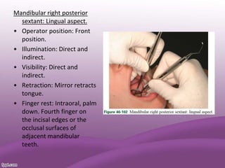Mandibular right posterior
sextant: Lingual aspect.
• Operator position: Front
position.
• Illumination: Direct and
indirect.
• Visibility: Direct and
indirect.
• Retraction: Mirror retracts
tongue.
• Finger rest: Intraoral, palm
down. Fourth finger on
the incisal edges or the
occlusal surfaces of
adjacent mandibular
teeth.
 