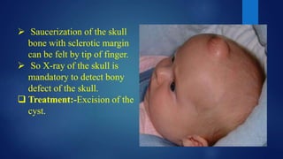 Saucerization of the skull
bone with sclerotic margin
can be felt by tip of finger.
 So X-ray of the skull is
mandatory to detect bony
defect of the skull.
 Treatment:-Excision of the
cyst.
 