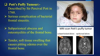  Pott’s Puffy Tumour:-
Described by Sir Percival Pott in
1760.
 Serious complication of bacterial
frontal sinusitis.
 Subperiosteal abscess and
osteomyelitis of the frontal bone.
 Tender, soft tissue swelling that
causes pitting edema over the
frontal bone.
 