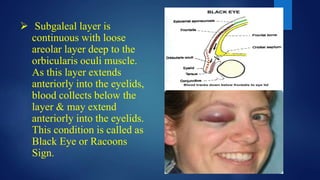  Subgaleal layer is
continuous with loose
areolar layer deep to the
orbicularis oculi muscle.
As this layer extends
anteriorly into the eyelids,
blood collects below the
layer & may extend
anteriorly into the eyelids.
This condition is called as
Black Eye or Racoons
Sign.
 