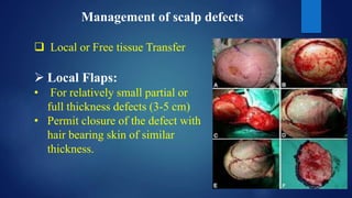 Management of scalp defects
 Local or Free tissue Transfer
 Local Flaps:
• For relatively small partial or
full thickness defects (3-5 cm)
• Permit closure of the defect with
hair bearing skin of similar
thickness.
 