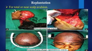 Replantation
 For total or near scalp avulsion.
 