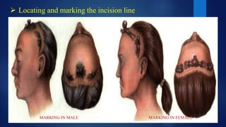  Locating and marking the incision line
MARKING IN MALE MARKING IN FEMALE
 