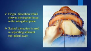  Finger dissection which
cleaves the areolar tissue
in the sub-galeal plane.
 Scalpel dissection is used
in separating adherent
sub-galeal layer.
 