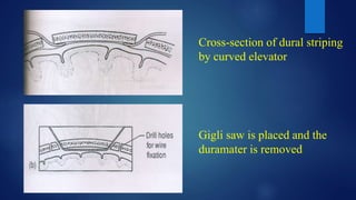 Cross-section of dural striping
by curved elevator
Gigli saw is placed and the
duramater is removed
 