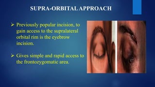 SUPRA-ORBITALAPPROACH
 Previously popular incision, to
gain access to the supralateral
orbital rim is the eyebrow
incision.
 Gives simple and rapid access to
the frontozygomatic area.
 