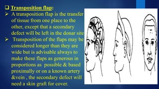  Transposition flap:
 A transposition flap is the transfer
of tissue from one place to the
other, except that a secondary
defect will be left in the donar site.
 Transposition of the flaps may be
considered longer than they are
wide but is advisable always to
make these flaps as generous in
proportions as possible & based
proximally or on a known artery
&vein , the secondary defect will
need a skin graft for cover.
 