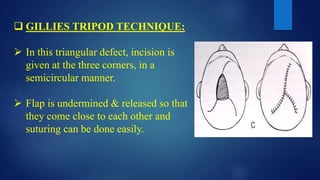  GILLIES TRIPOD TECHNIQUE:
 In this triangular defect, incision is
given at the three corners, in a
semicircular manner.
 Flap is undermined & released so that
they come close to each other and
suturing can be done easily.
 