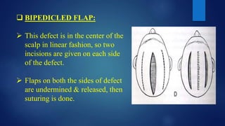  BIPEDICLED FLAP:
 This defect is in the center of the
scalp in linear fashion, so two
incisions are given on each side
of the defect.
 Flaps on both the sides of defect
are undermined & released, then
suturing is done.
 