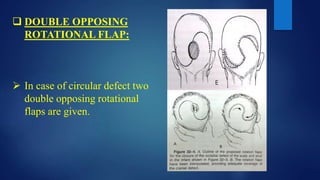  DOUBLE OPPOSING
ROTATIONAL FLAP:
 In case of circular defect two
double opposing rotational
flaps are given.
 