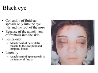 Black eye
• Collection of fluid can
spreads only into the eye
lids and the root of the nose
• Because of the attachment
of frontalis into the skin
• Posteriorly
– Attachment of occipitalis
muscle to the occipital and
temporal bones
• Laterally
– Attachment of aponeurosis to
the temporal fascia
 