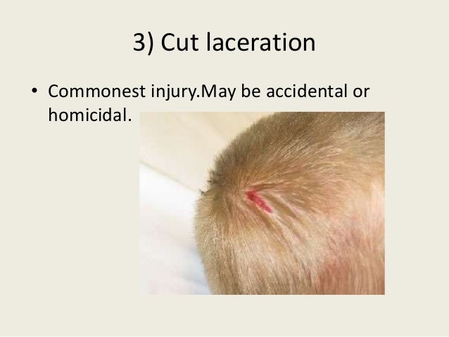 download scalp bones download scalp bones