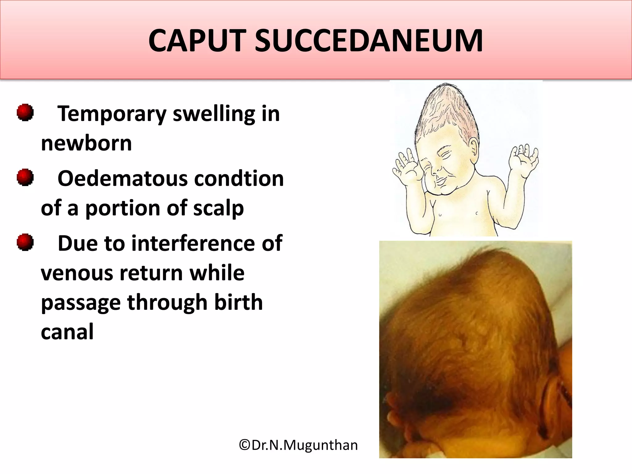 CAPUT SUCCEDANEUM
Temporary swelling in
newborn
Oedematous condtion
of a portion of scalp
Due to interference of
venous return while
passage through birth
canal
©Dr.N.Mugunthan
 
