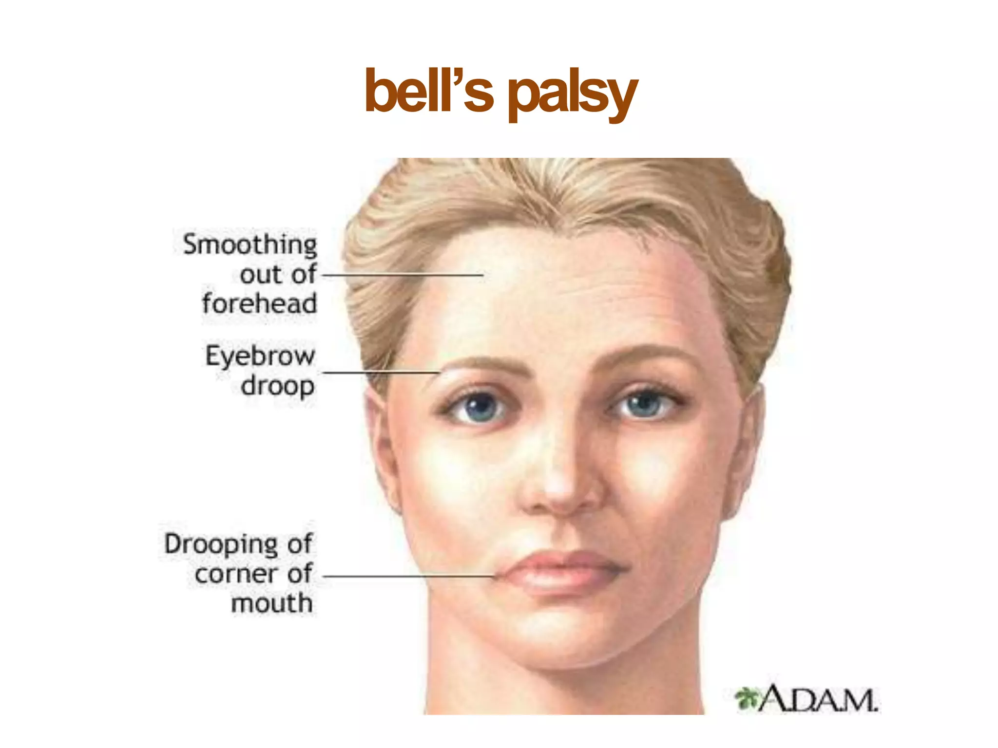 bell’spalsy
 