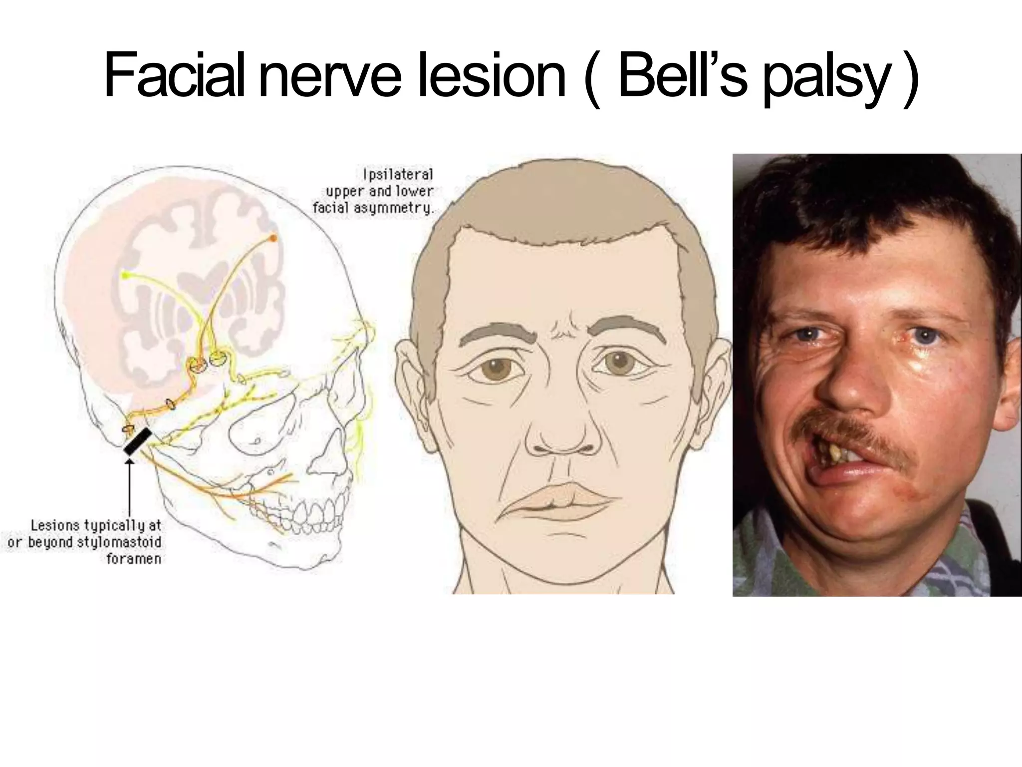 Facialnerve lesion ( Bell’s palsy)
 