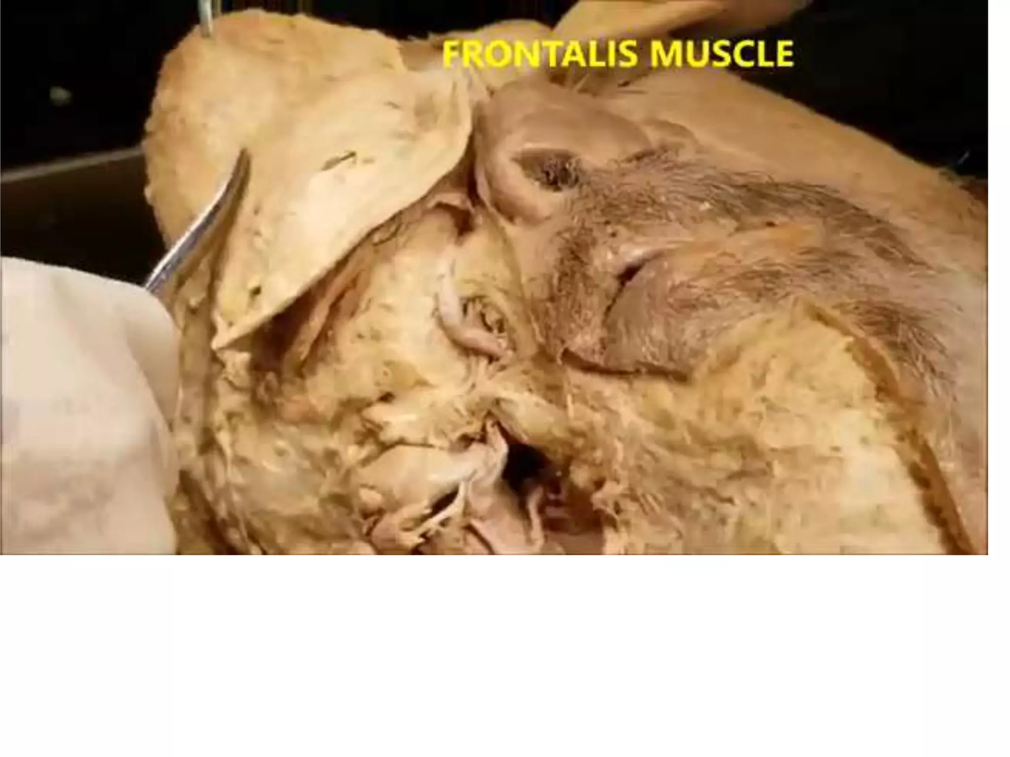 Scalpface scalp to face muscles and nerve supply 
