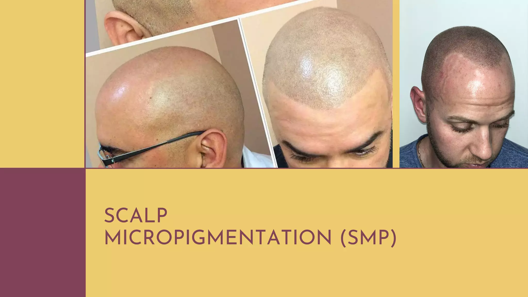 Scalp Micropigmentation (SMP) | Hair Tattoo | PDF