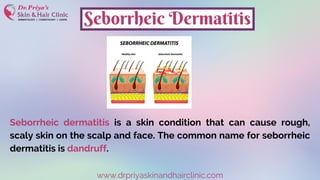 Seborrheic dermatitis is a skin condition that can cause rough,
scaly skin on the scalp and face. The common name for seborrheic
dermatitis is dandruff.
www.drpriyaskinandhairclinic.com
Seborrheic Dermatitis
 