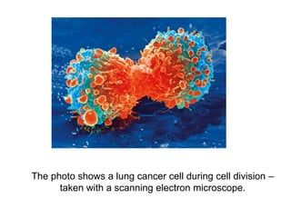 The photo shows a lung cancer cell during cell division –
taken with a scanning electron microscope.
 