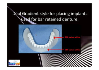 Single or Multiple Tooth Guides
 