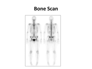 Bone Scan
 