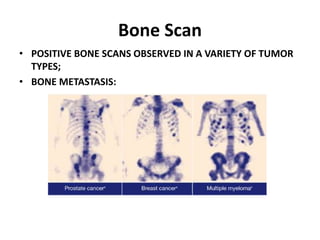 Bone Scan
• POSITIVE BONE SCANS OBSERVED IN A VARIETY OF TUMOR
TYPES;
• BONE METASTASIS:
 
