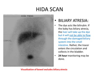 HIDA SCAN
• BILIARY ATRESIA:
• The dye acts like bilirubin. If
the baby has biliary atresia,
the liver will take up the dye
but it will not be able to flow
through the damaged biliary
system into the small
intestine. Rather, the tracer
enters the circulation and
collects in the bladder.
• 24 hour monitoring may be
done.
Visualization of bowel excludes biliary atresia
 