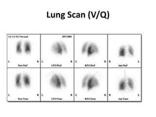 Lung Scan (V/Q)
 