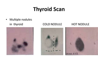 Thyroid Scan
• Multiple nodules
in thyroid COLD NODULE HOT NODULE
 