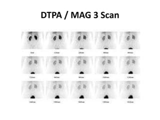 DTPA / MAG 3 Scan
 