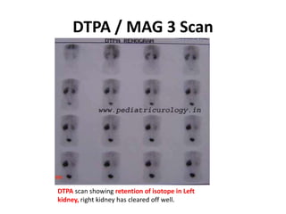 DTPA / MAG 3 Scan
DTPA scan showing retention of isotope in Left
kidney, right kidney has cleared off well.
 