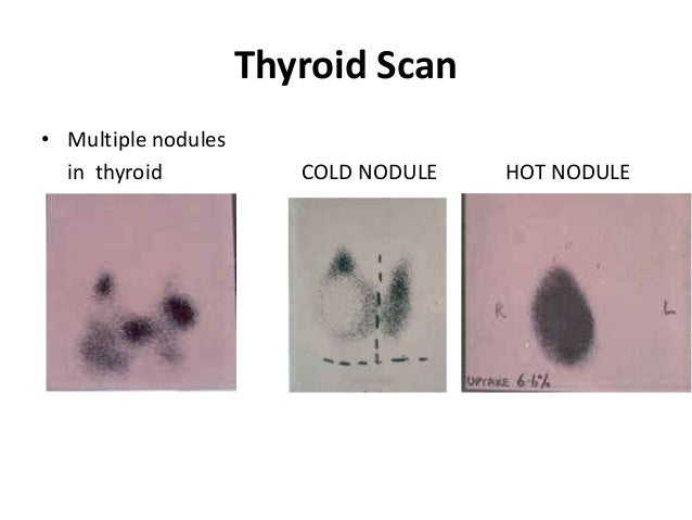 Hot nodule thyroid