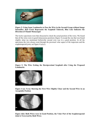 Figure 2: Using Same Landmarks to Pass the Wire in the Second Group without Image
Intensifier, Red Circle Represents the Scaphoid Tubercle, Blue Line Indicates the
Direction of Thumb Metacarpal
The twelve specimens were then dissected to check the actual position of the wires. We found
that all the wires were in good intraosseous positions (figure 3) except the one that was found
slightly ulnar (as mentioned before);the second wire was in a good position. In all the
specimens the wire always went through the proximal volar aspect of the trapezium and the
scaphotrapezial joint, see figure 4 (a,b,c).
Figure 3: The Wire Exiting the Dorsiproximal Scaphoid after Using the Proposed
Landmarks
Figure 4 (a): X-ray Showing the First Wire Slightly Ulnar and the Second Wire in an
Acceptable Position
Figure 4(b): Both Wires were in Good Position, the Volar Part of the Scaphotrapezial
Joint is Traversed by Both Wires
 