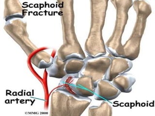 Scaphoid approaches by dr piyush rajesh imchrc indore | PPTX