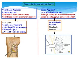 Scaphoid Fracture-RS.wjebndvuieboviewpdf | PDF