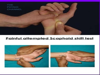 Scaphoid fracture (2)