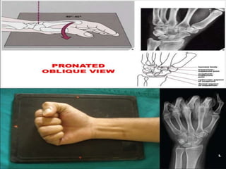 Scaphoid fracture (2)