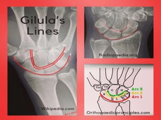 Scaphoid fracture (2)