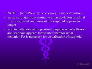 Scaphoid fracture (2)