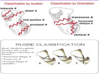 Scaphoid fracture (2)