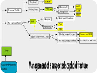 Scaphoid fracture (2)